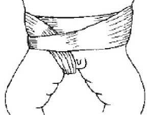 疝气的最新疗法揭秘,探索最新疝气治疗方法