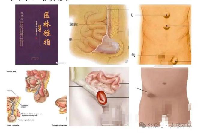 疝气的最新疗法揭秘,探索最新疝气治疗方法