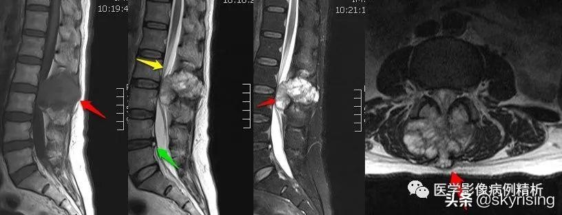 最新脊索瘤治疗,一场探索自然美景的治愈之旅