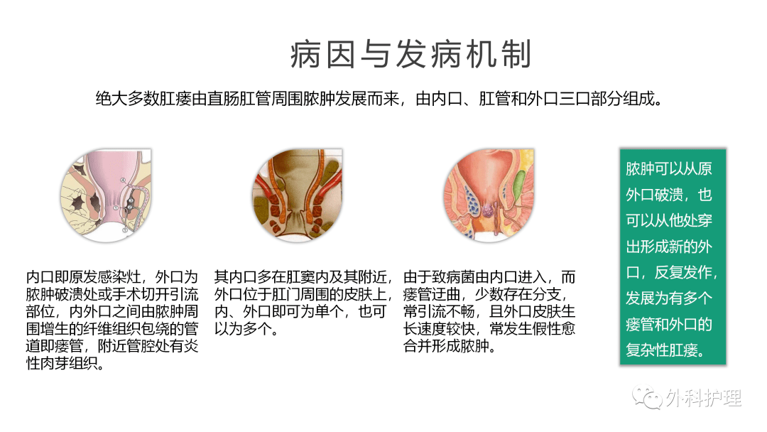 肛瘘最新治疗论述