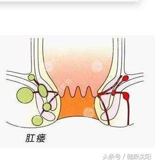 最新痔疮治疗,科普知识,要点详解