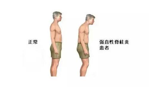 美国强直性脊柱炎最新研究动态与进展