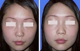 激光祛雀斑手术价格,深入解析与观点阐述