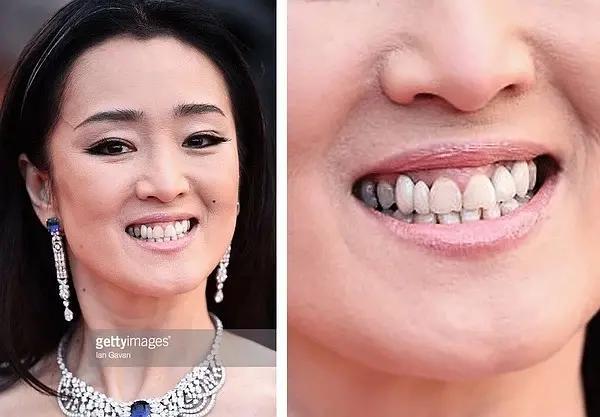 🌟明星都是假牙吗?揭秘牙齿背后的真相✨