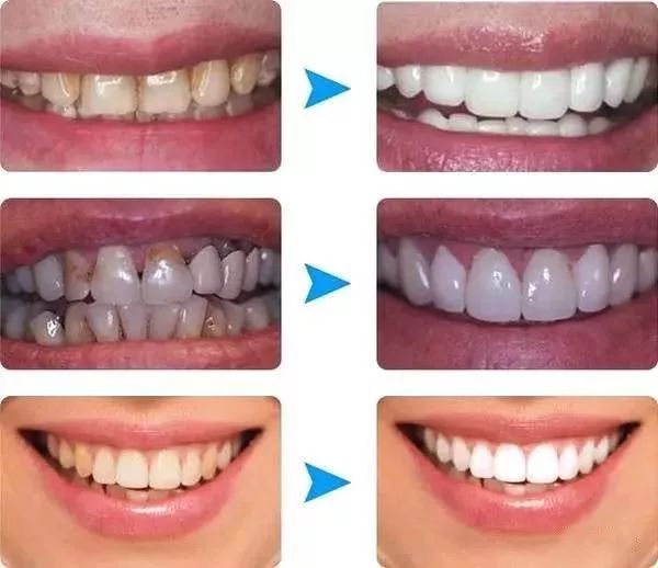 牙齿不齐的明星,如何借助科技力量重塑自信微笑——最新牙齿矫正科技产品介绍