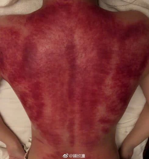 最新滴痧操作指南,一步步教你完成这项任务