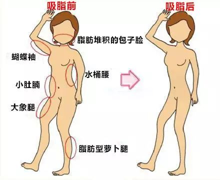 最新吸脂手术方法,小胖的逆袭之旅与友情的温暖纽带