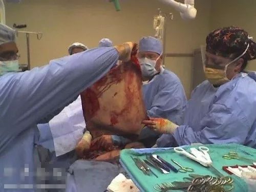 最新吸脂手术方法,小胖的逆袭之旅与友情的温暖纽带